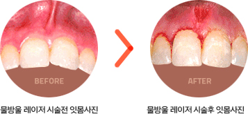 뮬방울레이저시술전후사진