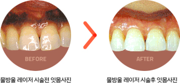 뮬방울레이저시술전후사진