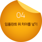 04.임플란트 위 치아를 넣기