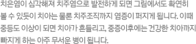 치은염이 심각해져 치주염으로 발전하게 되면 그림에서도 확연히 볼 수 있듯이 치아는 물론 치주조직까지 염증이 퍼지게 됩니다. 이때 중등도 이상이 되면 치아가 흔들리고, 중증이후에는 건강한 치아까지 빠지게 하는 아주 무서운 병이 됩니다.